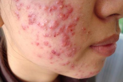 Sức tàn phá kinh hoàng cho làn da khi sử dụng mỹ phẩm chứa corticoid