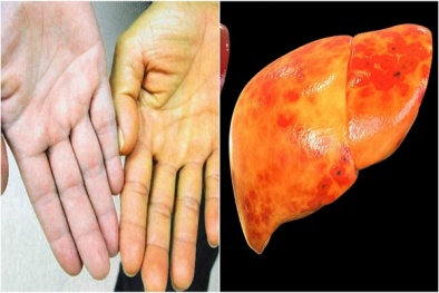 Mới 15 tuổi mà gan đã 'vàng óng' do nhiễm mỡ vì món ăn quen thuộc này
