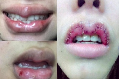 Tạo hình môi trái tim: Coi chừng dị dạng