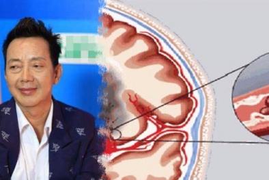 Căn bệnh khiến diễn viên hài Khánh Nam nguy kịch nguy hiểm đến mức nào?