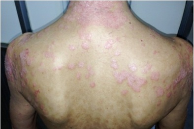Toàn thân chảy mủ vì dùng đông y không rõ nguồn gốc chữa bệnh