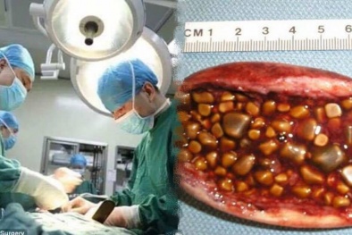 Gắp 200 viên sỏi thận từ cơ thể người phụ nữ thường xuyên bỏ ăn sáng