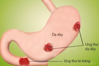 Tại sao người mắc ung thư đã chữa khỏi lại tái phát?
