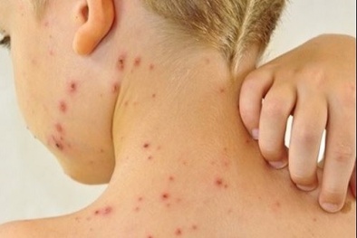 Bé gái bị teo não do côn trùng cắn, cha mẹ chớ bỏ qua