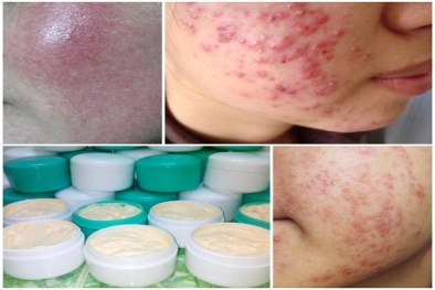 Dưỡng trắng siêu tốc và cái giá không hề rẻ cho giấc mơ làm đẹp