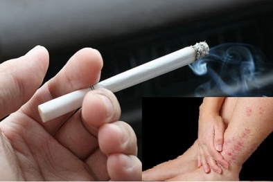Hút thuốc lá có thể gây viêm da cơ địa khó chữa