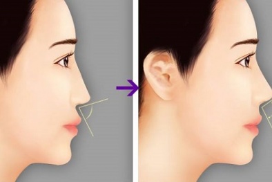 5 cách nâng mũi tự nhiên thon gọn không cần phẫu thuật