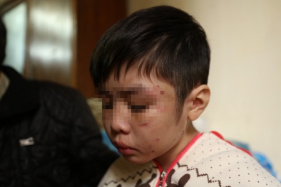 Hành trình bỏ trốn trong đau đớn khỏi nhà bố và mẹ kế của cháu bé 10 tuổi bị bạo hành