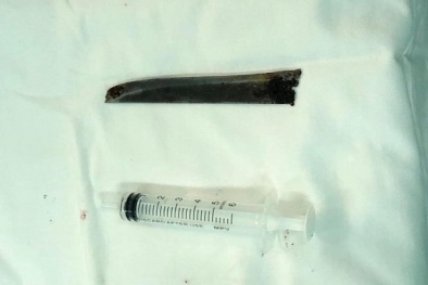 Thanh niên 'may mắn' khi vẫn sống được với lưỡi dao 12cm trong lưng suốt 4 năm