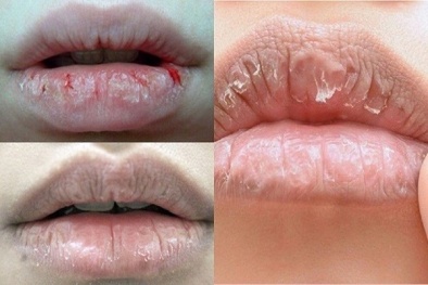 Da khô nẻ do trời lạnh: Cách trị đơn giản không hề tốn tiền