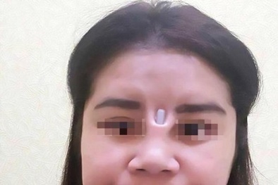 Nâng mũi làm đẹp, một phụ nữ bị cây silicone chòi ra đâm thủng mặt