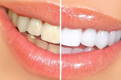 Không cần tẩy trắng vẫn có hàm răng sáng bóng với 5 thực phẩm này