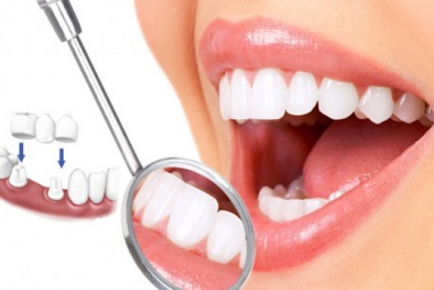 Những biến chứng đáng sợ của việc bọc răng thẩm mỹ