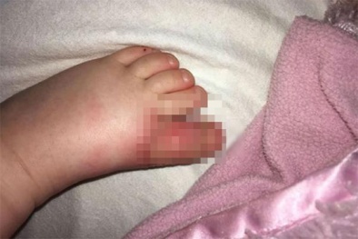 Bé gái bị biến dạng chân do thói quen tận dụng giày dép cũ của mẹ