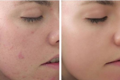 Bỏ túi cách chăm sóc da mụn tại nhà 'siêu hiệu quả'
