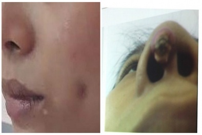 Ham làm đẹp giá rẻ, áp xe má, mũi bất ngờ lồi 'cục lạ'