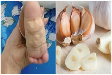 Con lãnh hậu quả nghiêm trọng khi mẹ nghe lời đồn đại đắp tỏi chữa bệnh cho con