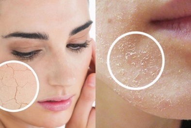 Những sai lầm có thể ‘hủy hoại’ làn da vào mùa đông