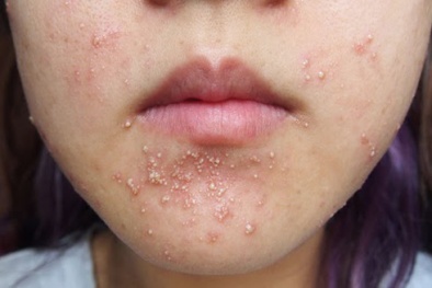 Bất ngờ mụn trứng các có liên quan đến nguy cơ trầm cảm nặng