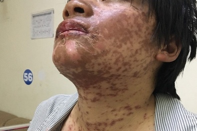Tự mua thuốc trị sốt, đau đầu uống, cô gái bị biến dạng khuôn mặt