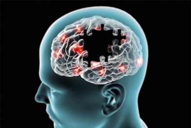Bệnh Parkinson: Thừa canxi có thể gây nguy hiểm