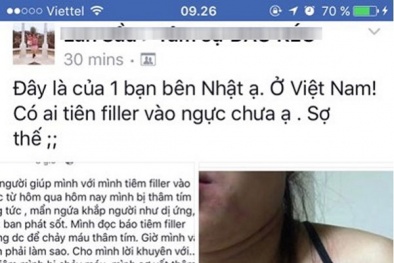 Một cô gái sau khi tiêm filler làm đẹp: Ngực căng tức, bầm tím