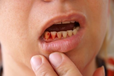 90% người Việt bị sâu răng, viêm lợi