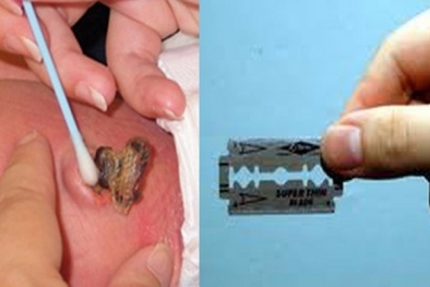 Đẻ con tại nhà dùng dao lam cắt rốn, mẹ suýt hại chết con