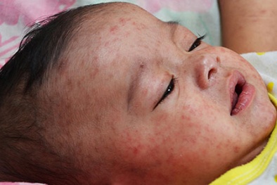 Lầm tưởng 'chết người' về mối liên hệ giữa bệnh rubella, sởi và quai bị