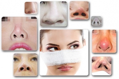 Trước khi nâng mũi hãy biết đến những biến chứng này để cân nhắc