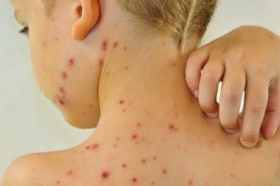Nguy cơ nhiễm trùng máu nếu tùy tiện dùng Đông y chữa thủy đậu
