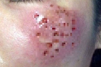 Nguy cơ hỏng mặt do làm đẹp bằng laser