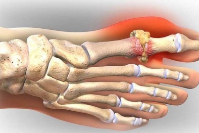 Những đồ ăn làm giảm cơn đau của người bệnh gút
