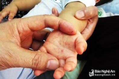 Bệnh tay chân miệng, ho gà có nguy cơ bùng phát dịch tại Nghệ An