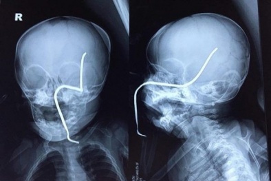 Bé gái 8 tháng tuổi bất ngờ bị thanh sắt đâm thủng sọ khi đang chơi đùa