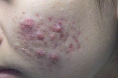 Nhiền biến chứng khó lường chỉ từ mụn trứng cá
