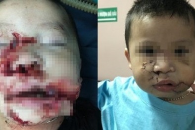 Hà Nội: Bé trai 2 tuổi bị chó đẻ cắn nát mặt, tổn thương nghiêm trọng