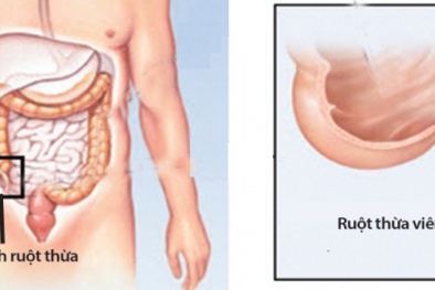 Viêm ruột thừa và những triệu chứng không thể bỏ qua