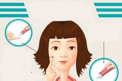 Dùng kem đánh răng trị mụn chỉ khiến tình trạng thêm nghiêm trọng