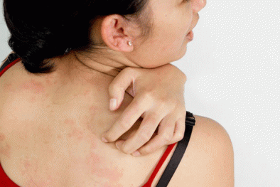 Đừng coi thường ngứa da, đó có thể là biểu hiện bệnh lý của ung thư máu