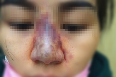 Vì sao tiêm filler lại tiềm ẩn nguy hiểm?