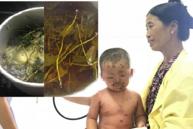 Nguy cơ trẻ nhỏ bị nhiễm trùng, viêm loét vì tắm lá dại trị mẩn ngứa