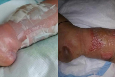 Đi làm móng, một phụ nữ suýt mất chân vì nhiễm trùng nặng