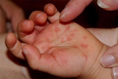 Dịch bệnh tay chân miệng có xu hướng gia tăng, Bộ Y tế ra công văn khẩn