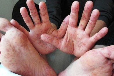 Phát hiện sự thay đổi nhóm gene của virus gây bệnh tay chân miệng