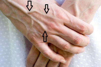 Nổi gân xanh - có thể là dấu hiệu bệnh nguy hiểm