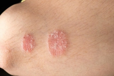 Mắc bệnh vẩy nến có thể dẫn đến một số chứng bệnh đường ruột
