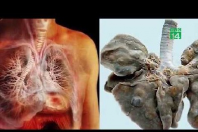 Nam thanh niên 'nuôi' cả bầy sán trong phổi vì món ăn quen thuộc