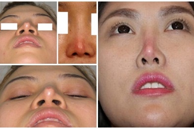 Những nguy hại từ việc nâng mũi bằng sụn tự thân