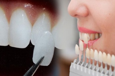Trào lưu gắn răng khểnh làm đẹp: Coi chừng rước họa vào thân!